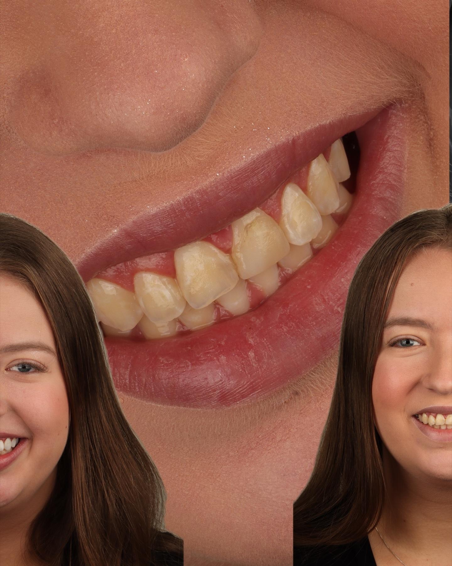 Sorriso antes do tratamento estético