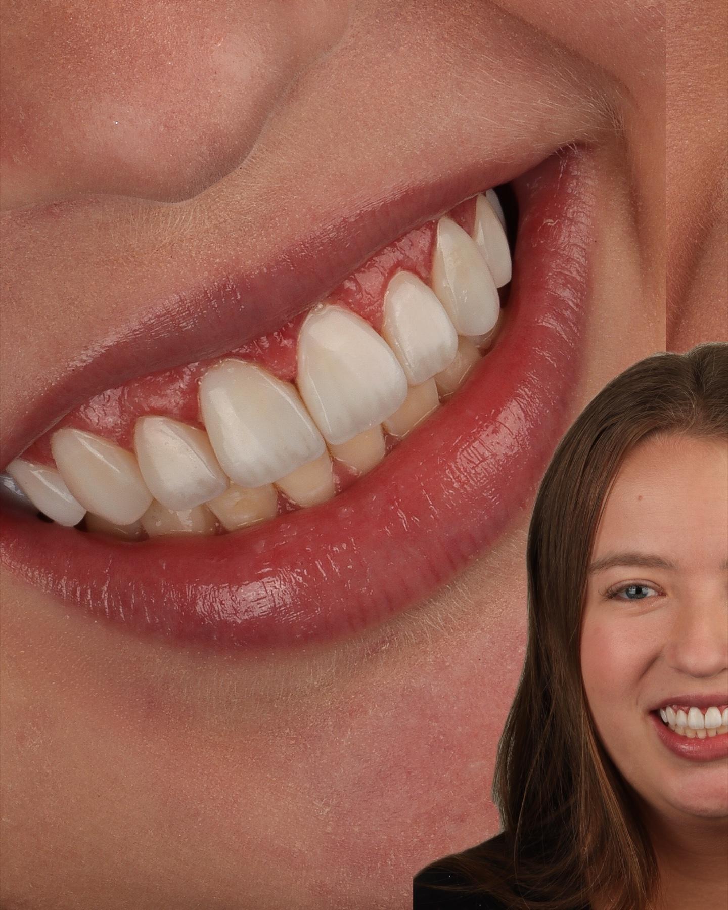 Sorriso após o tratamento estético