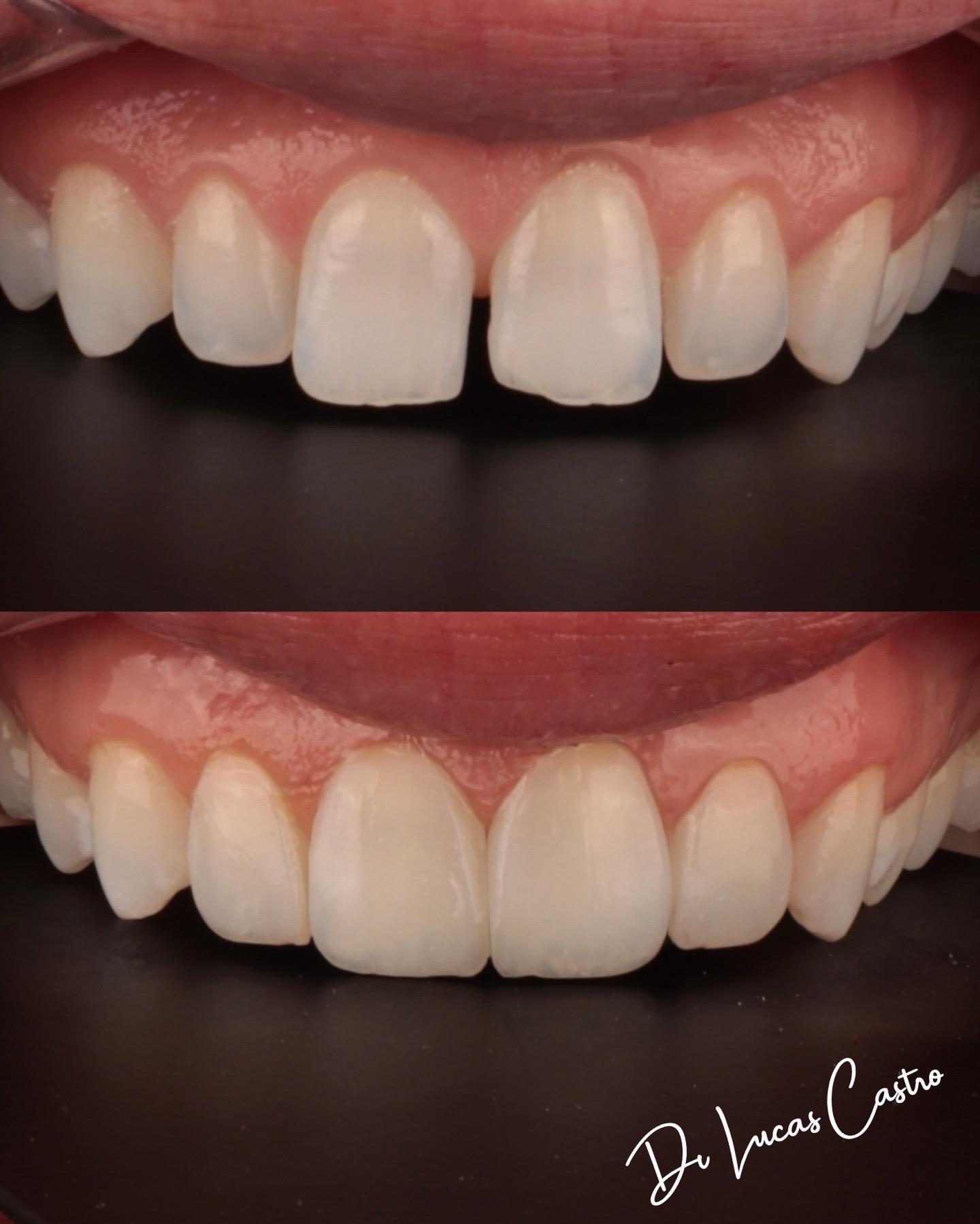 Antes e depois de restauração estética