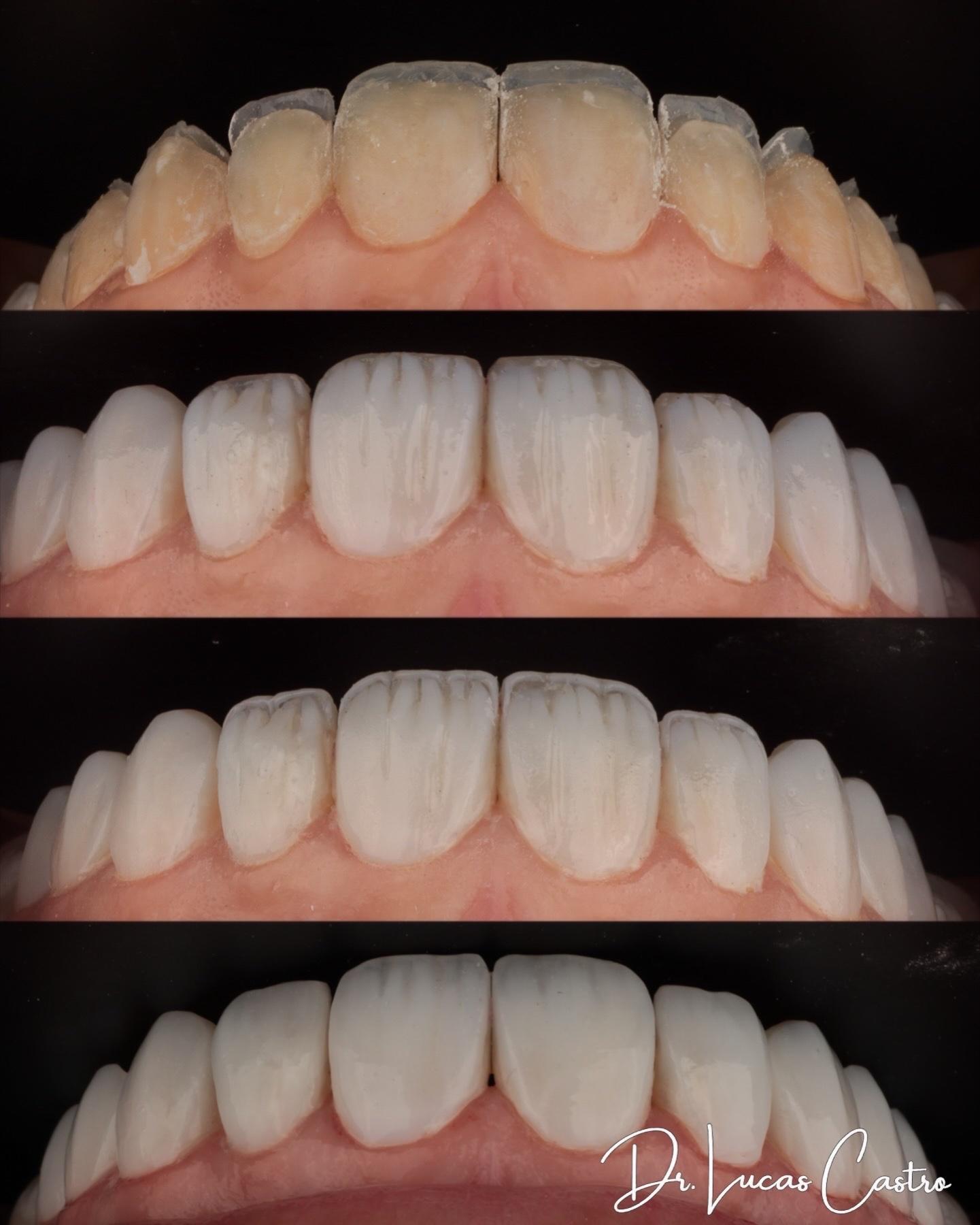 Sequência clínica do planejamento de um sorriso