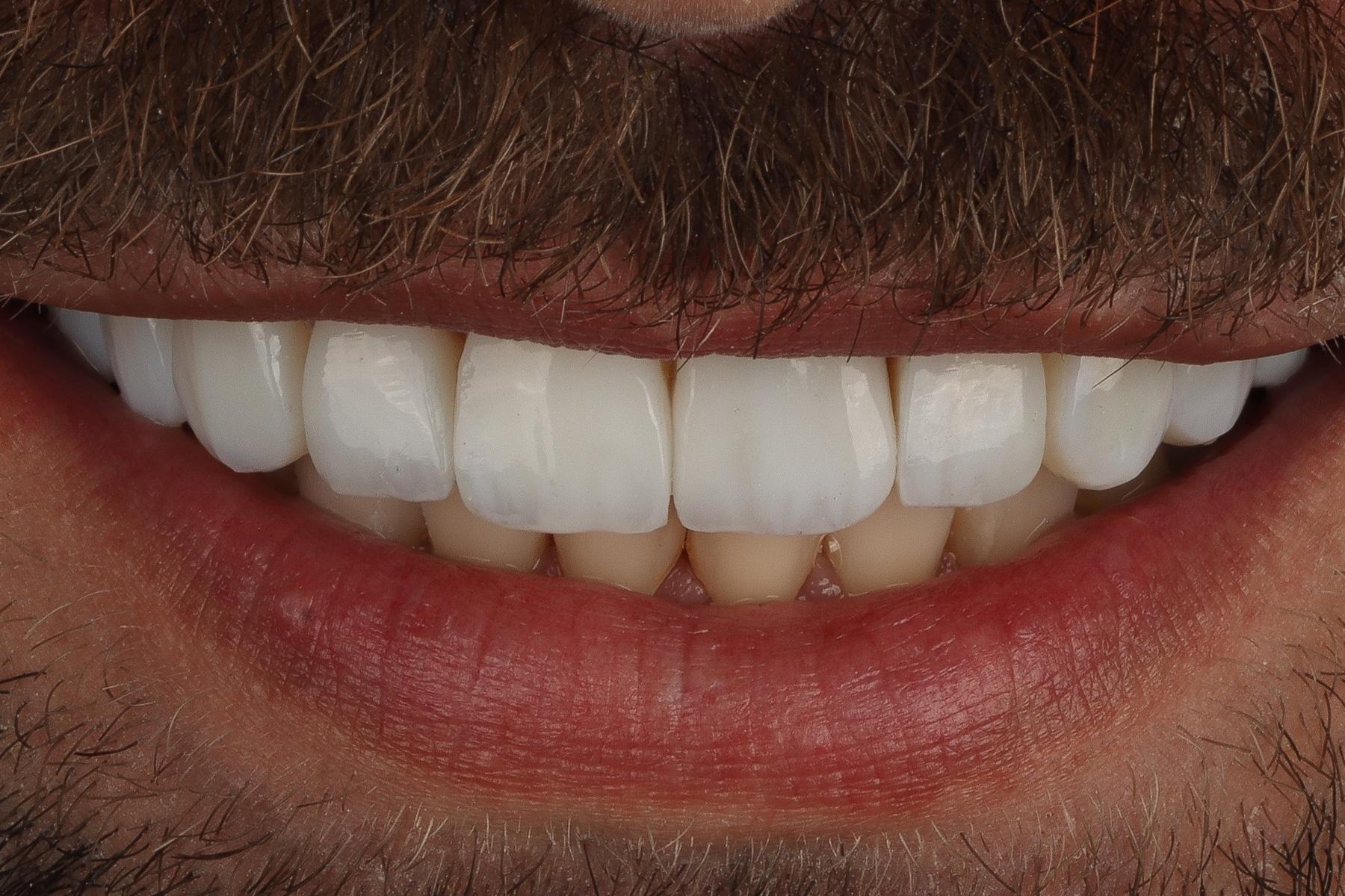 Detalhe frontal de um sorriso após tratamento estético
